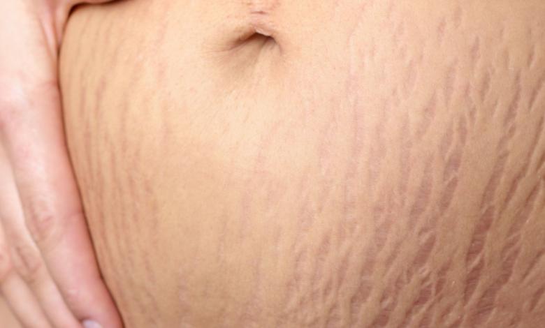 Rid of Stretch Marks