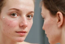 Discover the Best Remedies to Clear Acne at Home